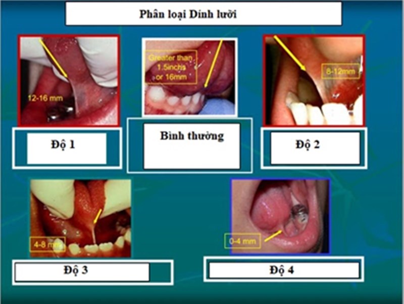 Dính lưỡi (Ankyloglossia) ở trẻ em